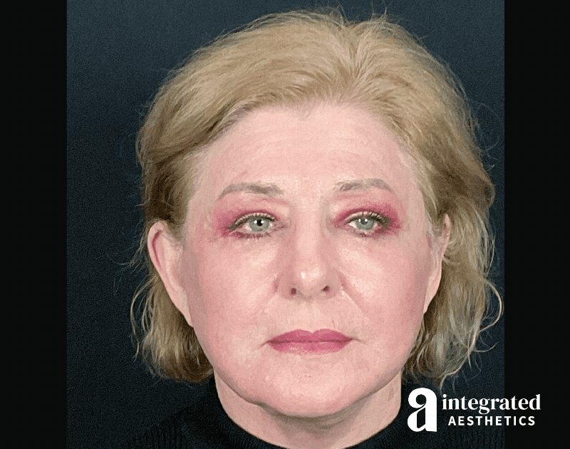 Blepharoplasty Before & After Gallery - Patient 133211225 - Image 2