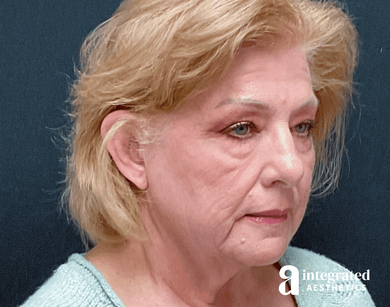 Blepharoplasty Before & After Gallery - Patient 133211225 - Image 7