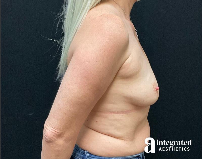 Breast Augmentation Before & After Gallery - Patient 133211573 - Image 9