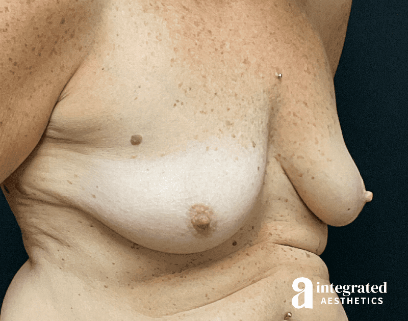 Breast Augmentation Before & After Gallery - Patient 133211607 - Image 5