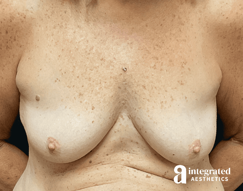 Breast Augmentation Before & After Gallery - Patient 133211607 - Image 1