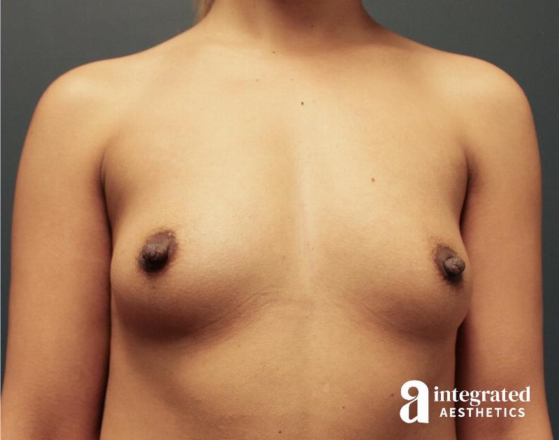 Breast Augmentation Before & After Gallery - Patient 133212377 - Image 1