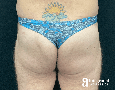 Butt Lift Before & After Gallery - Patient 133212535 - Image 2