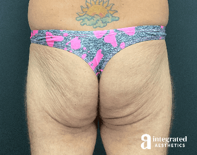 Butt Lift Before & After Gallery - Patient 133212535 - Image 1