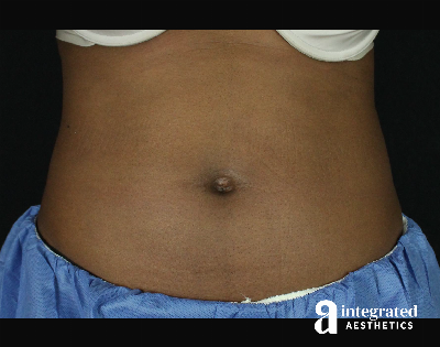 CoolSculpting Before & After Gallery - Patient 133212648 - Image 1