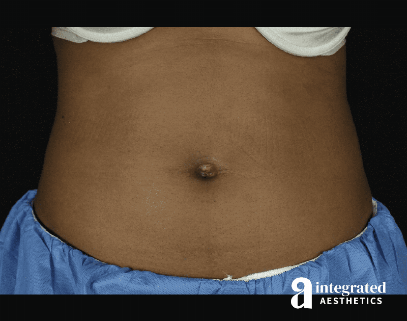 CoolSculpting Before & After Gallery - Patient 133212648 - Image 1