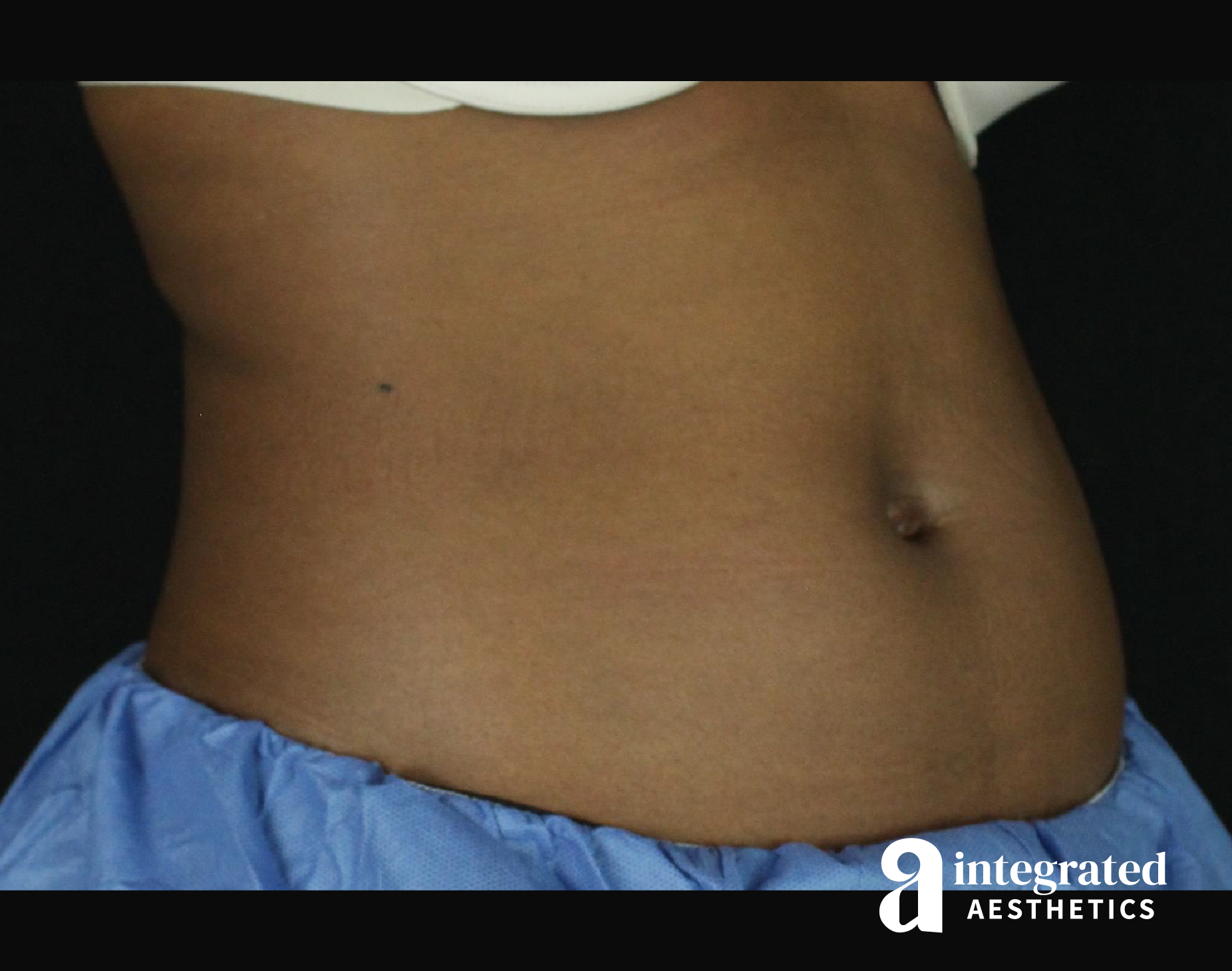 CoolSculpting Before & After Gallery - Patient 133212648 - Image 3