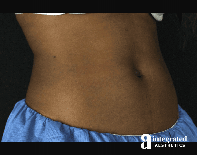 CoolSculpting Before & After Gallery - Patient 133212648 - Image 4