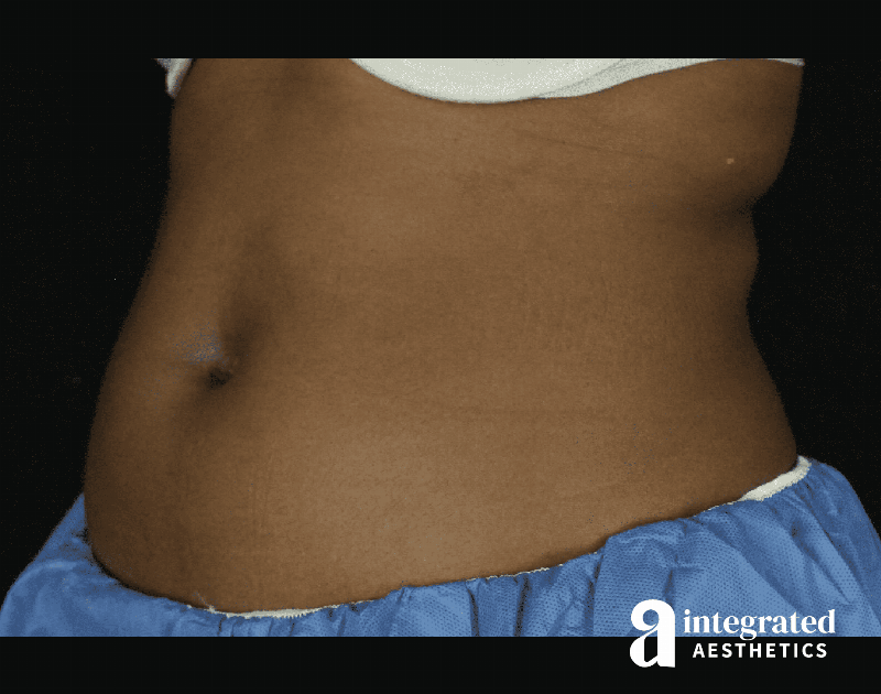 CoolSculpting Before & After Gallery - Patient 133212648 - Image 5