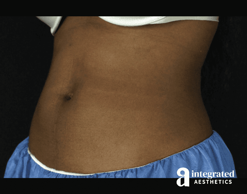 CoolSculpting Before & After Gallery - Patient 133212648 - Image 6