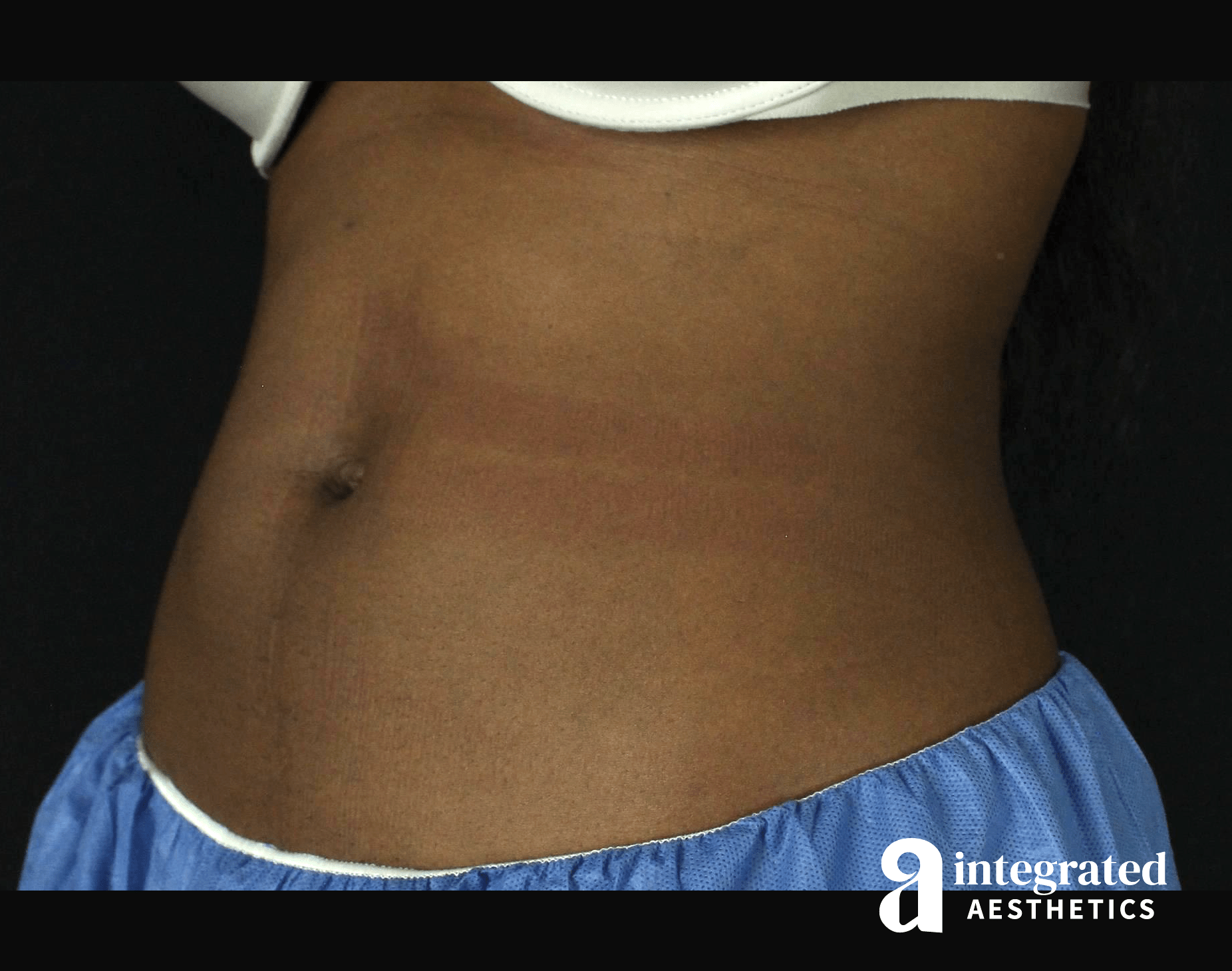 CoolSculpting Before & After Gallery - Patient 133212648 - Image 6