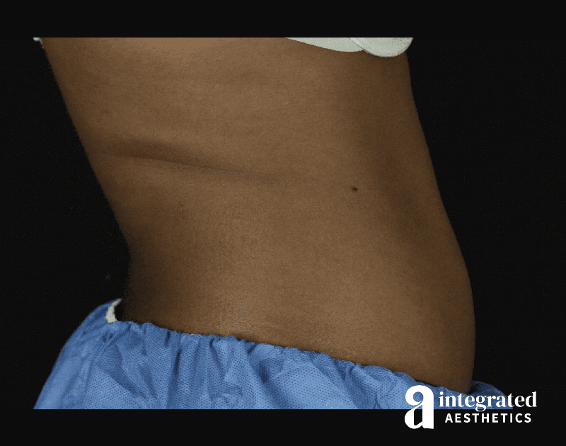 CoolSculpting Before & After Gallery - Patient 133212648 - Image 7