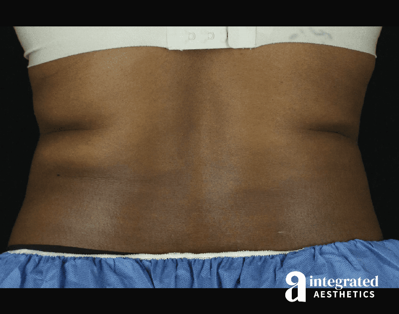 CoolSculpting Before & After Gallery - Patient 133212648 - Image 11