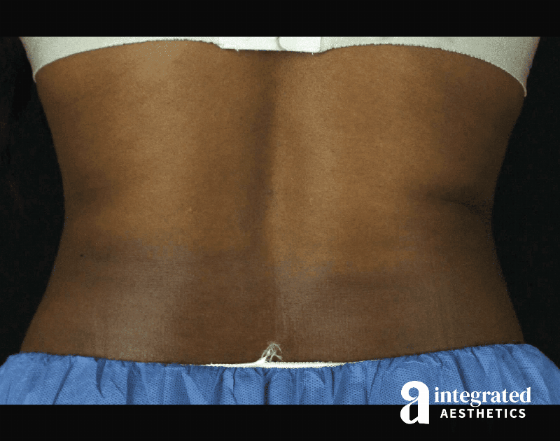 CoolSculpting Before & After Gallery - Patient 133212648 - Image 12