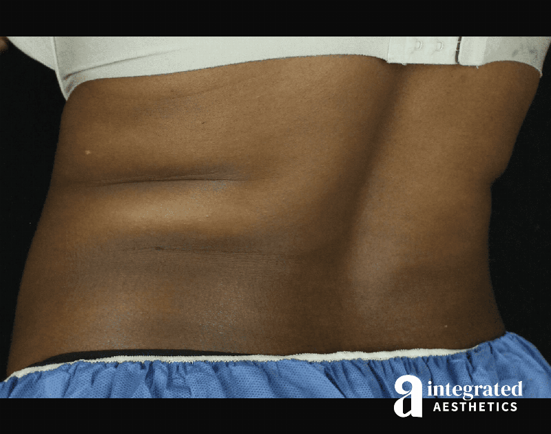 CoolSculpting Before & After Gallery - Patient 133212648 - Image 13