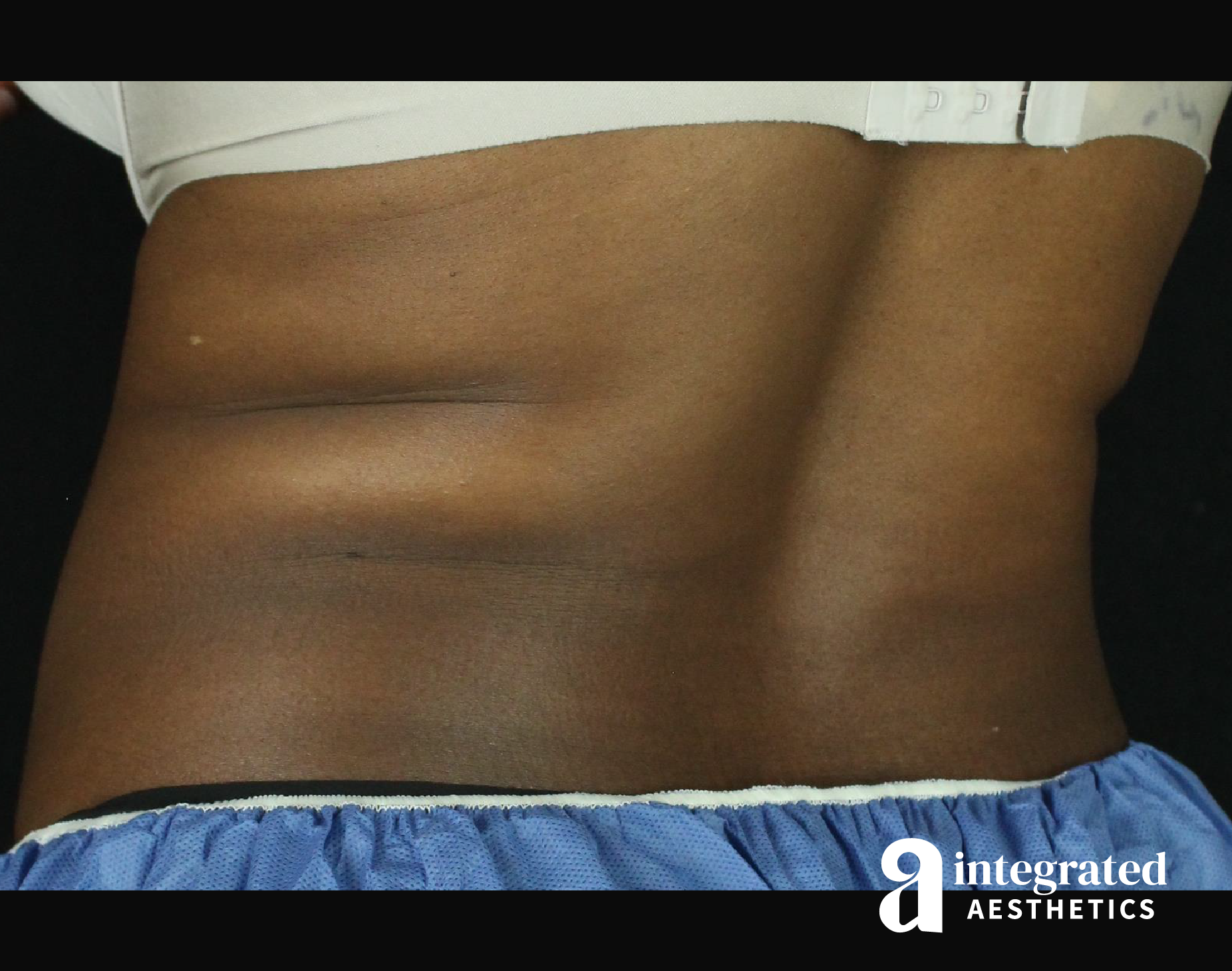 CoolSculpting Before & After Gallery - Patient 133212648 - Image 13