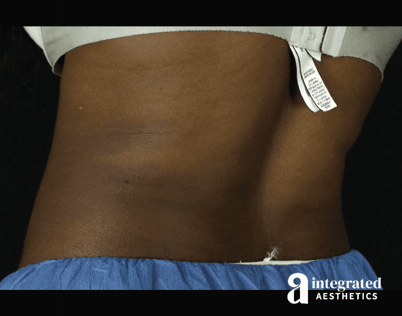 CoolSculpting Before & After Gallery - Patient 133212648 - Image 14