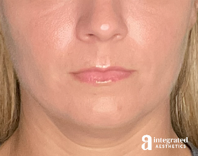 Lip Filler Before & After Gallery - Patient 157266203 - Image 1