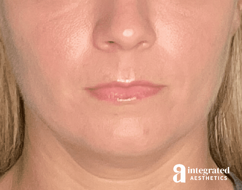 Dermal Fillers Before & After Gallery - Patient 133212623 - Image 1