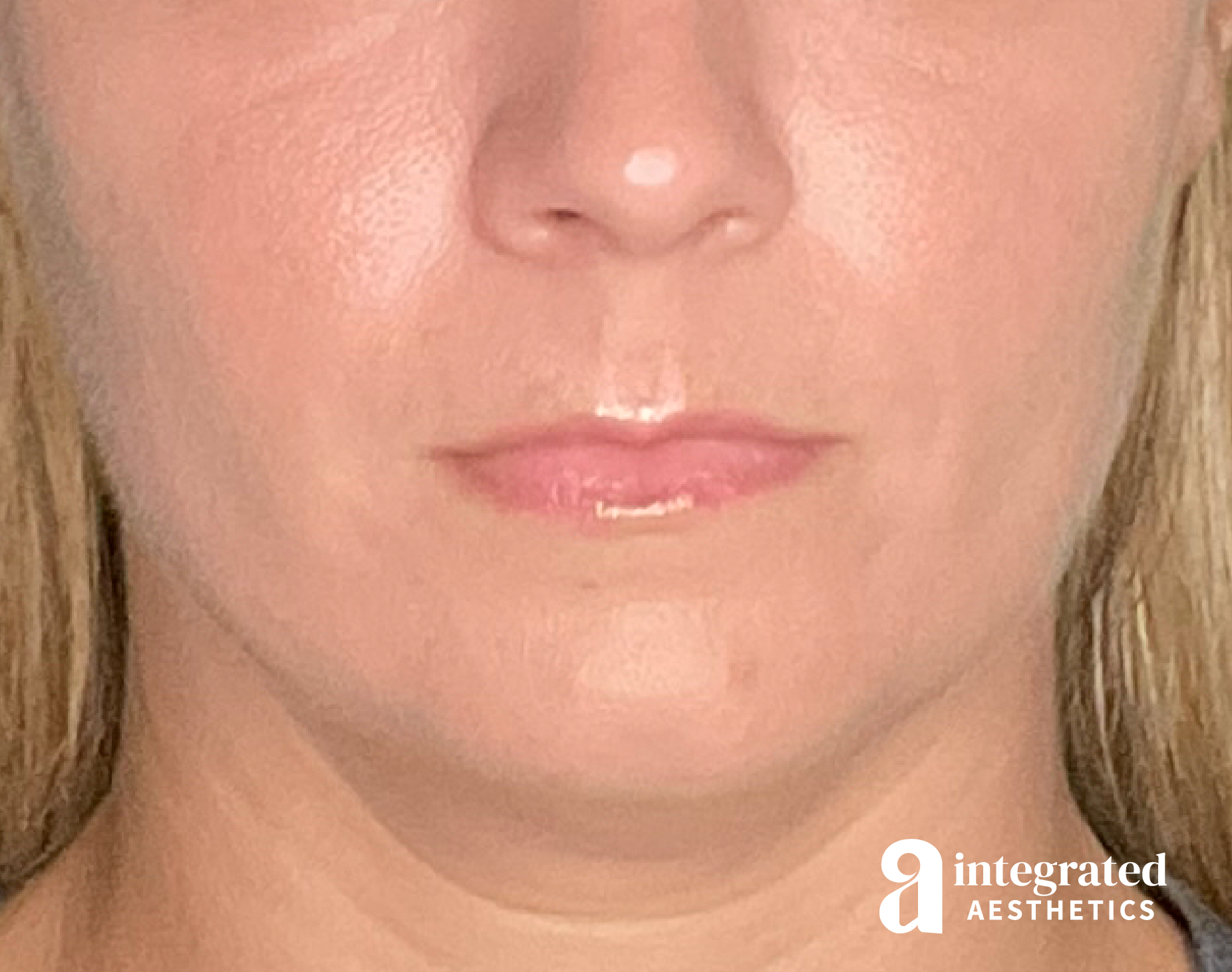 Lip Filler Before & After Gallery - Patient 157266203 - Image 1