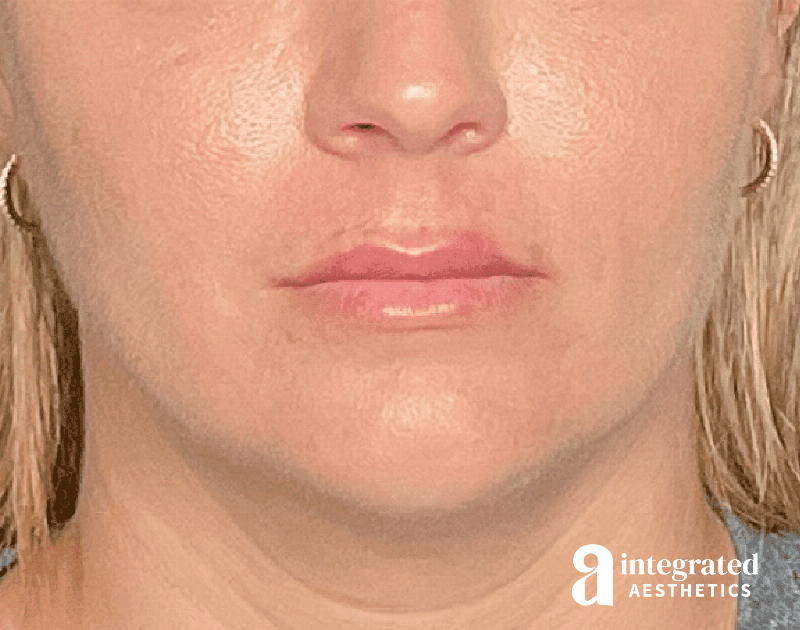 Dermal Fillers Before & After Gallery - Patient 133212623 - Image 2