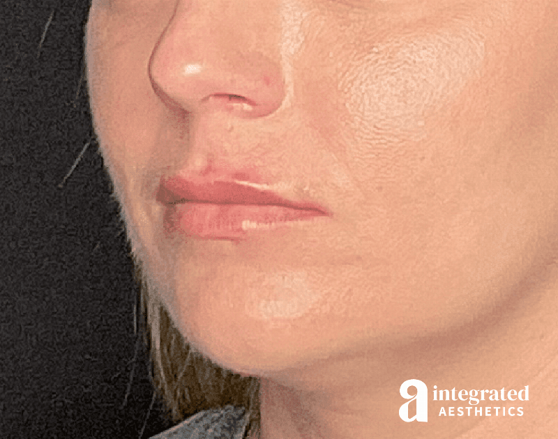 Dermal Fillers Before & After Gallery - Patient 133212623 - Image 4