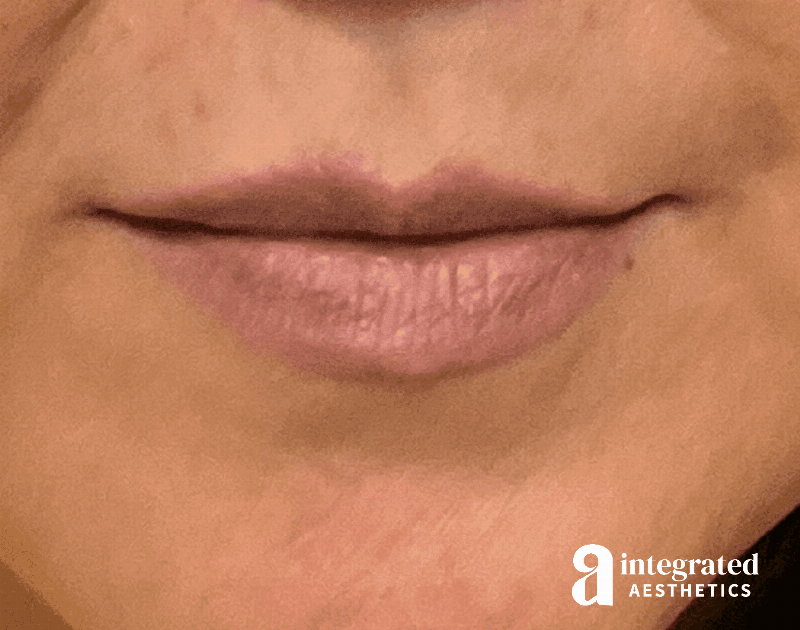 Dermal Fillers Before & After Gallery - Patient 133212621 - Image 1