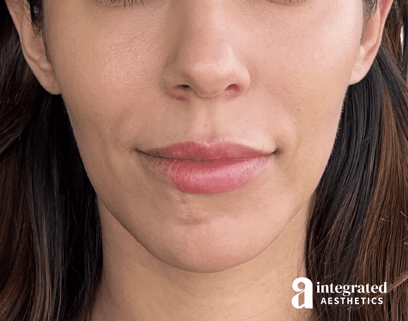 Dermal Fillers Before & After Gallery - Patient 133212646 - Image 1