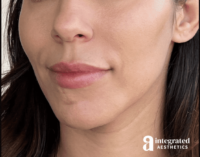 Dermal Fillers Before & After Gallery - Patient 133212646 - Image 7