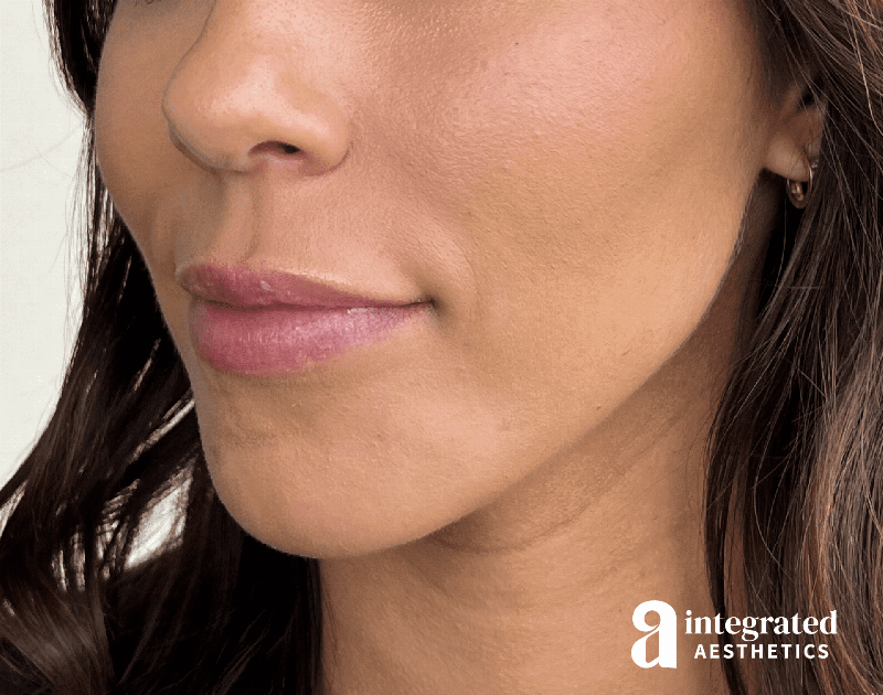 Dermal Fillers Before & After Gallery - Patient 133212646 - Image 8