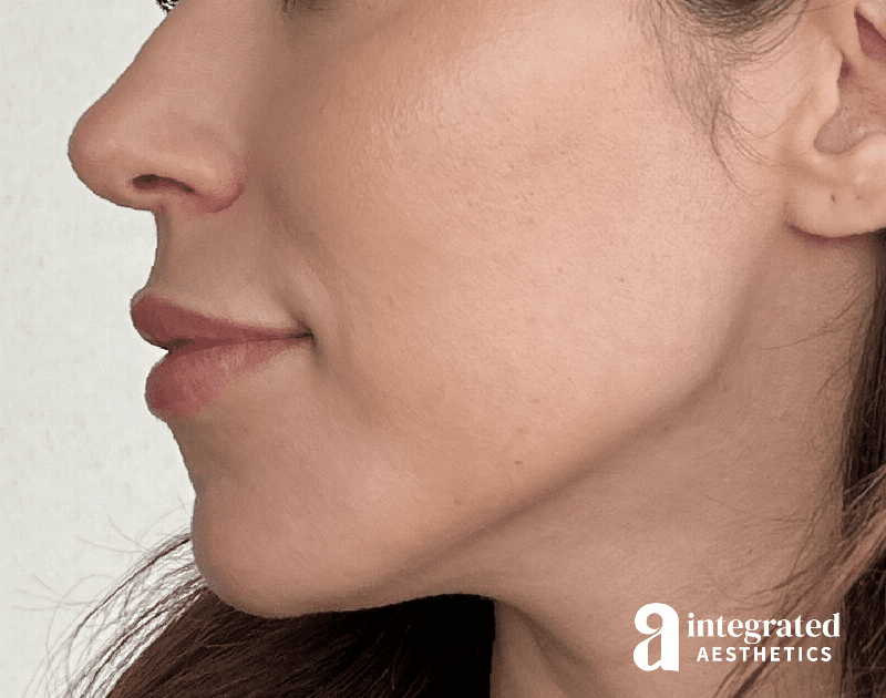 Dermal Fillers Before & After Gallery - Patient 133212646 - Image 9