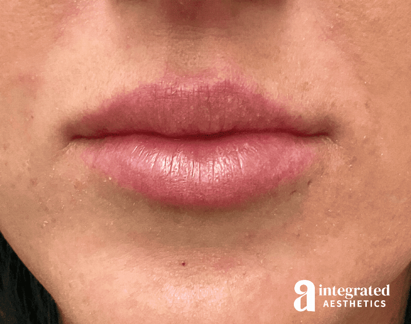 Dermal Fillers Before & After Gallery - Patient 133212645 - Image 1