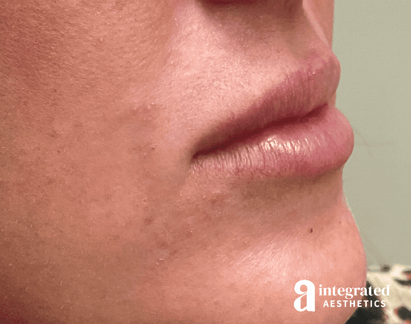 Dermal Fillers Before & After Gallery - Patient 133212645 - Image 3