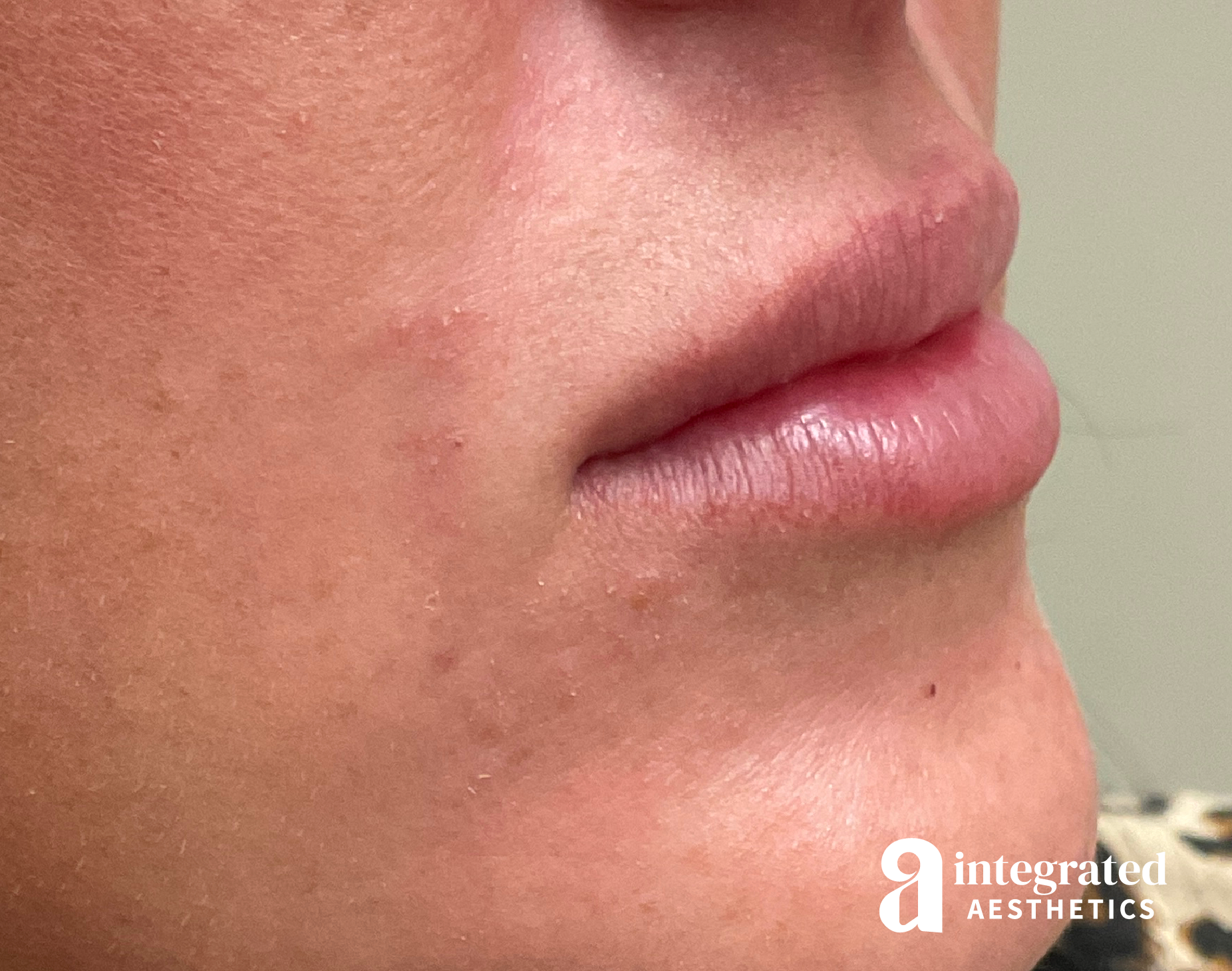 Dermal Fillers Before & After Gallery - Patient 133212645 - Image 3