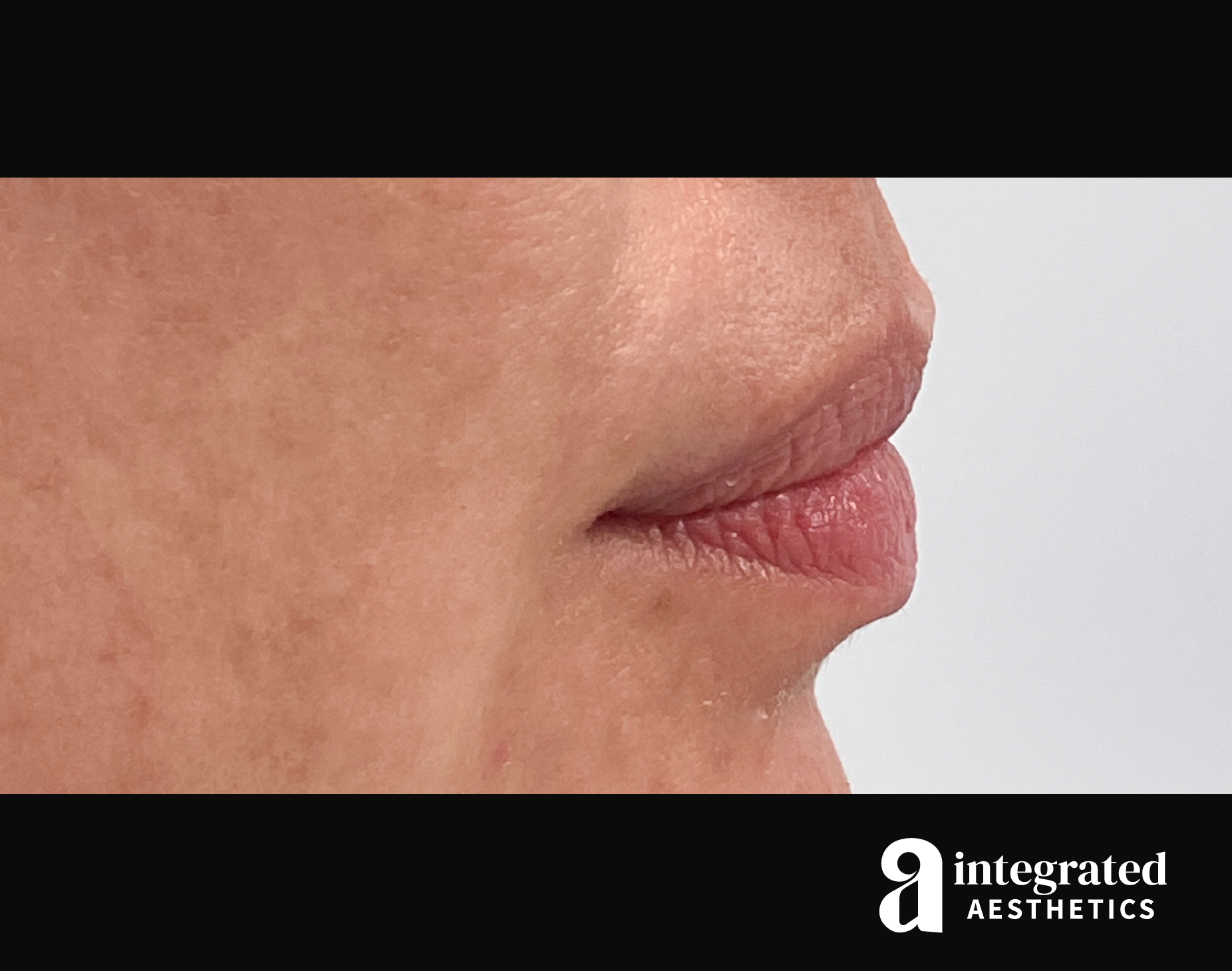 Lip Filler Before & After Gallery - Patient 157266202 - Image 5