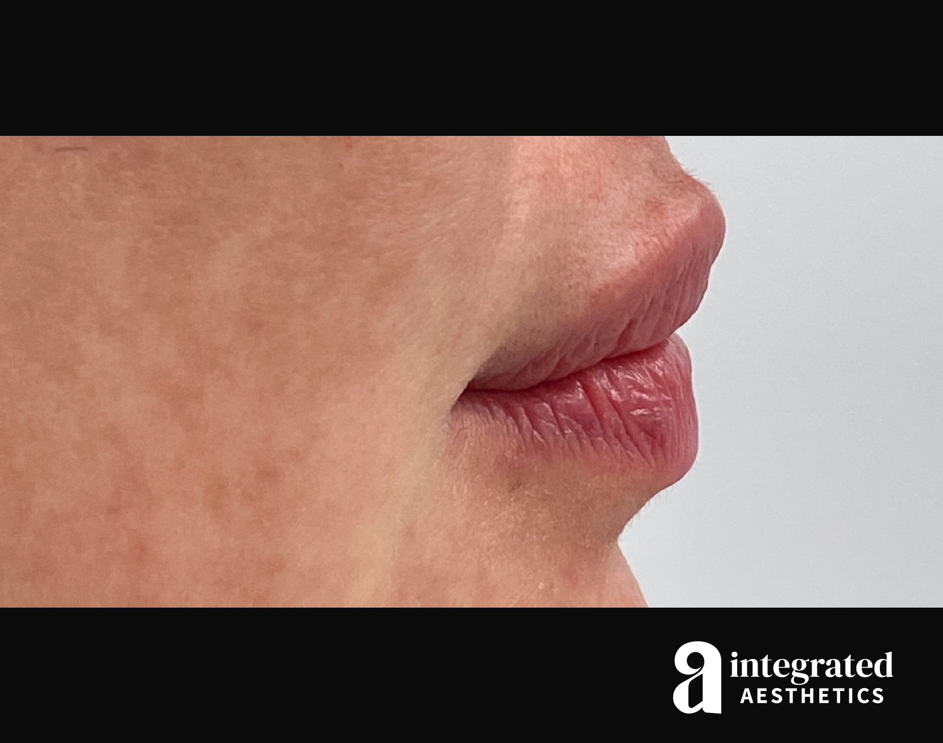 Lip Filler Before & After Gallery - Patient 157266202 - Image 6