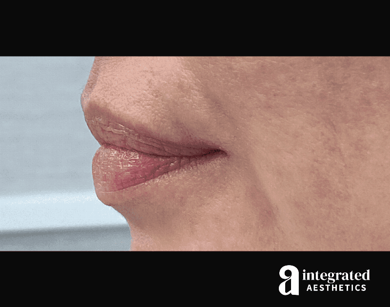 Dermal Fillers Before & After Gallery - Patient 133212657 - Image 7