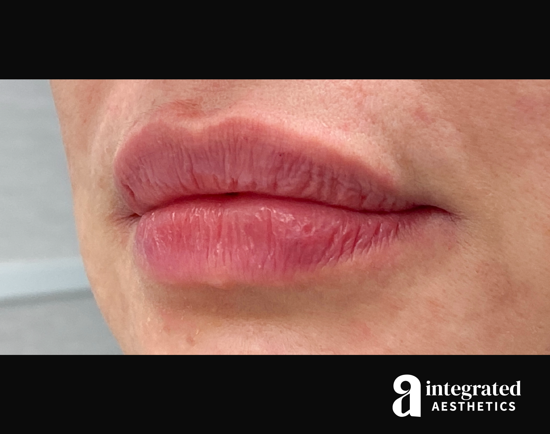 Lip Filler Before & After Gallery - Patient 157266202 - Image 10