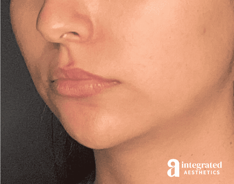 Dermal Fillers Before & After Gallery - Patient 133212666 - Image 4