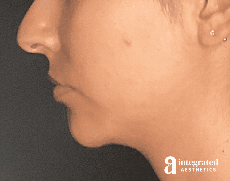 Dermal Fillers Before & After Gallery - Patient 133212666 - Image 8