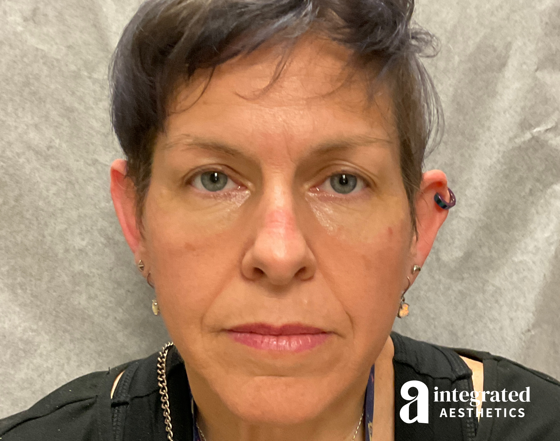 Dermal Fillers Before & After Gallery - Patient 133212669 - Image 2