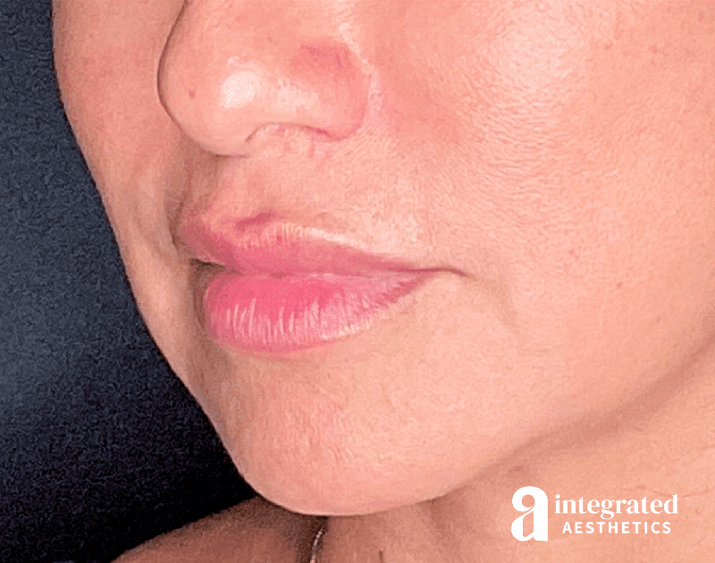 Dermal Fillers Before & After Gallery - Patient 133212668 - Image 3