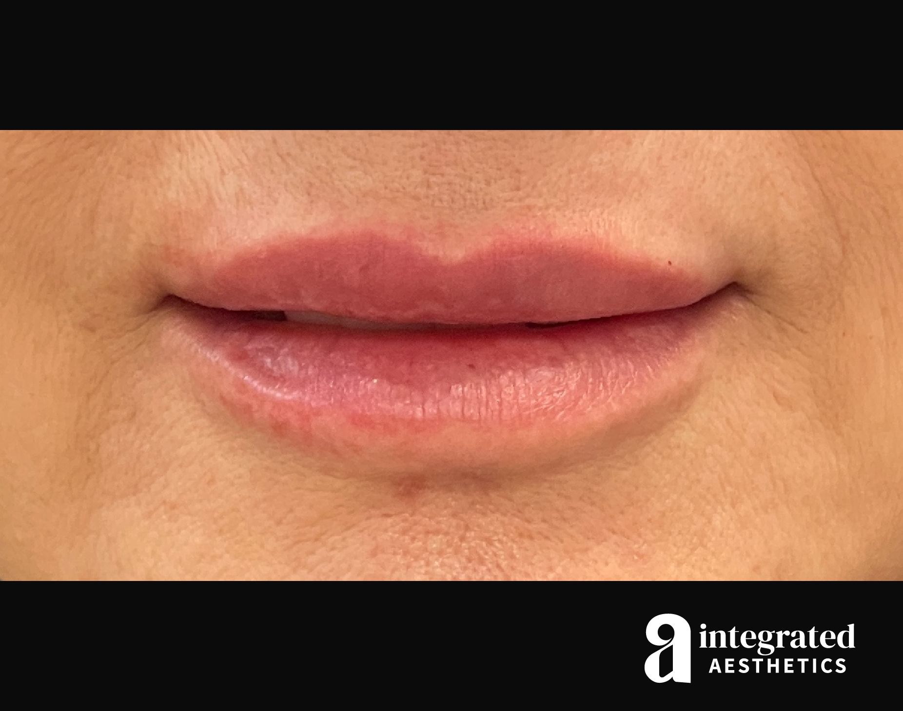 Dermal Fillers Before & After Gallery - Patient 133212672 - Image 2