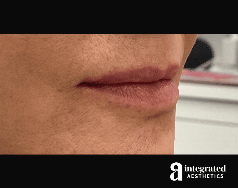 Dermal Fillers Before & After Gallery - Patient 133212672 - Image 3