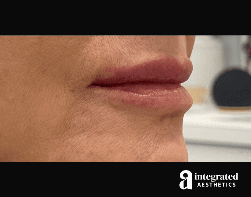 Dermal Fillers Before & After Gallery - Patient 133212672 - Image 4