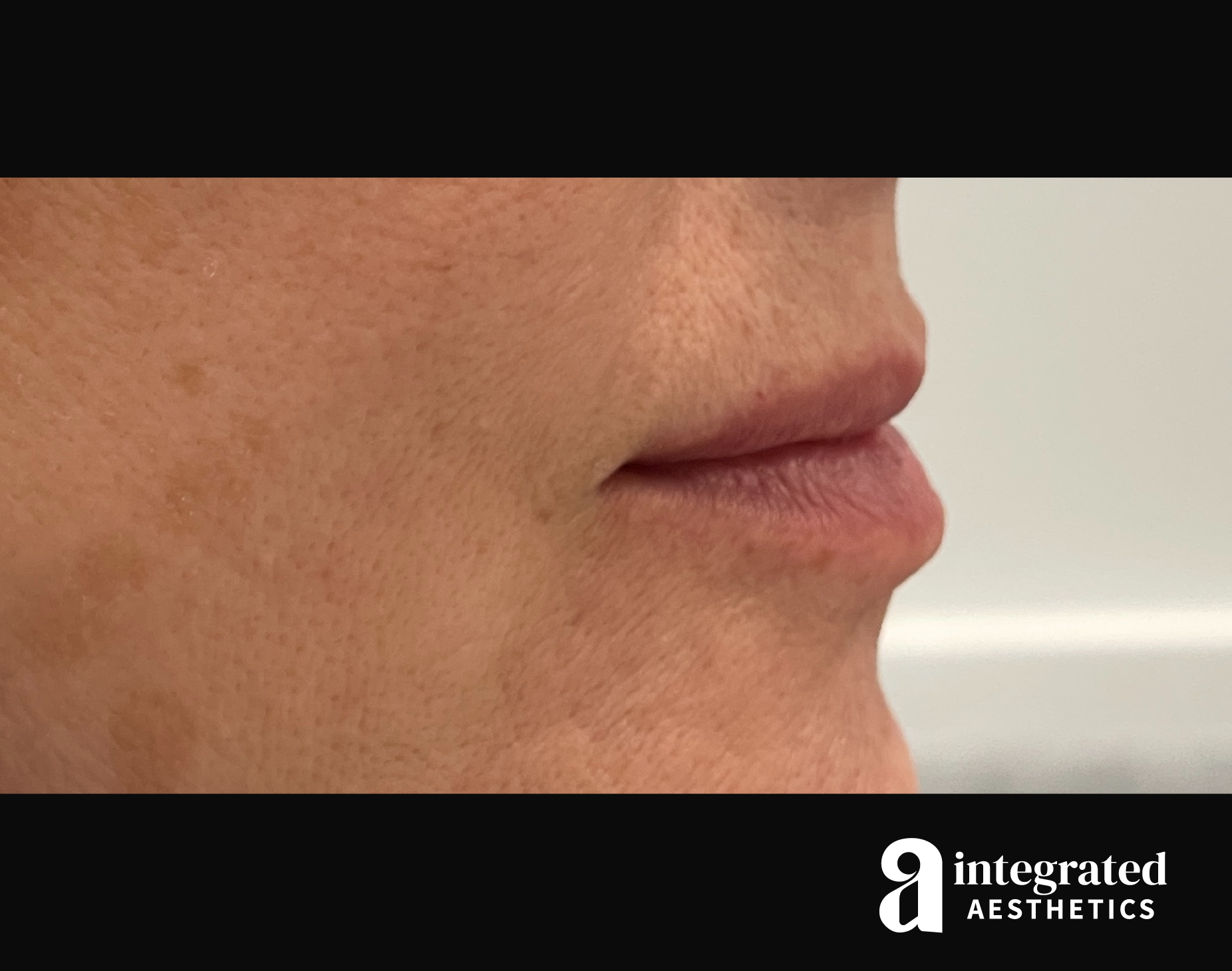 Dermal Fillers Before & After Gallery - Patient 133212672 - Image 5