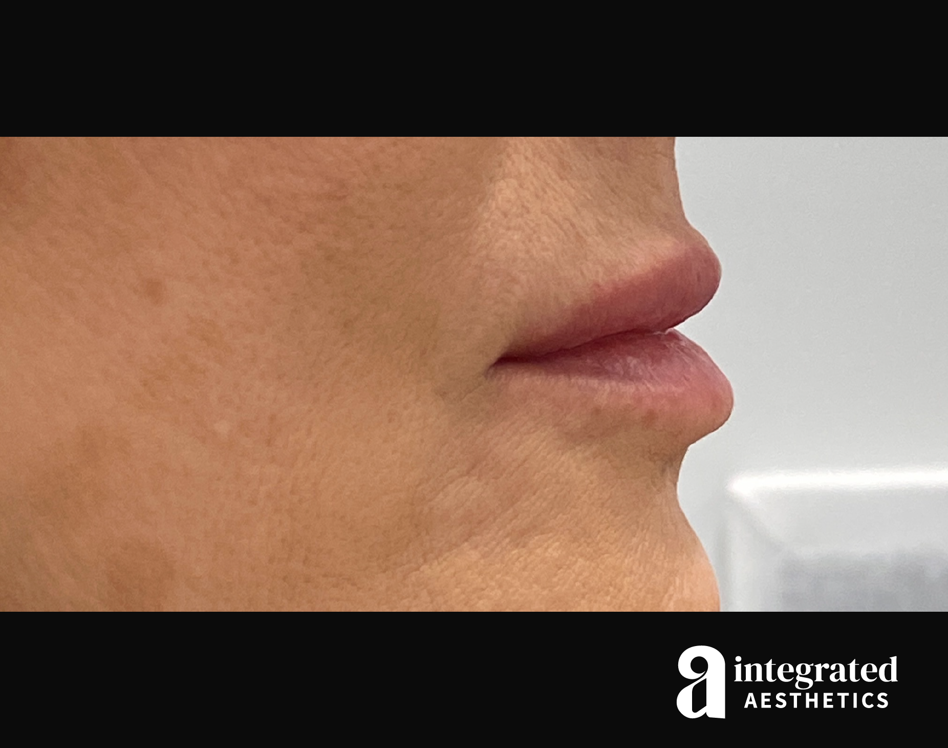 Dermal Fillers Before & After Gallery - Patient 133212672 - Image 6