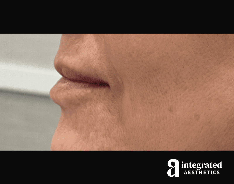 Dermal Fillers Before & After Gallery - Patient 133212672 - Image 7