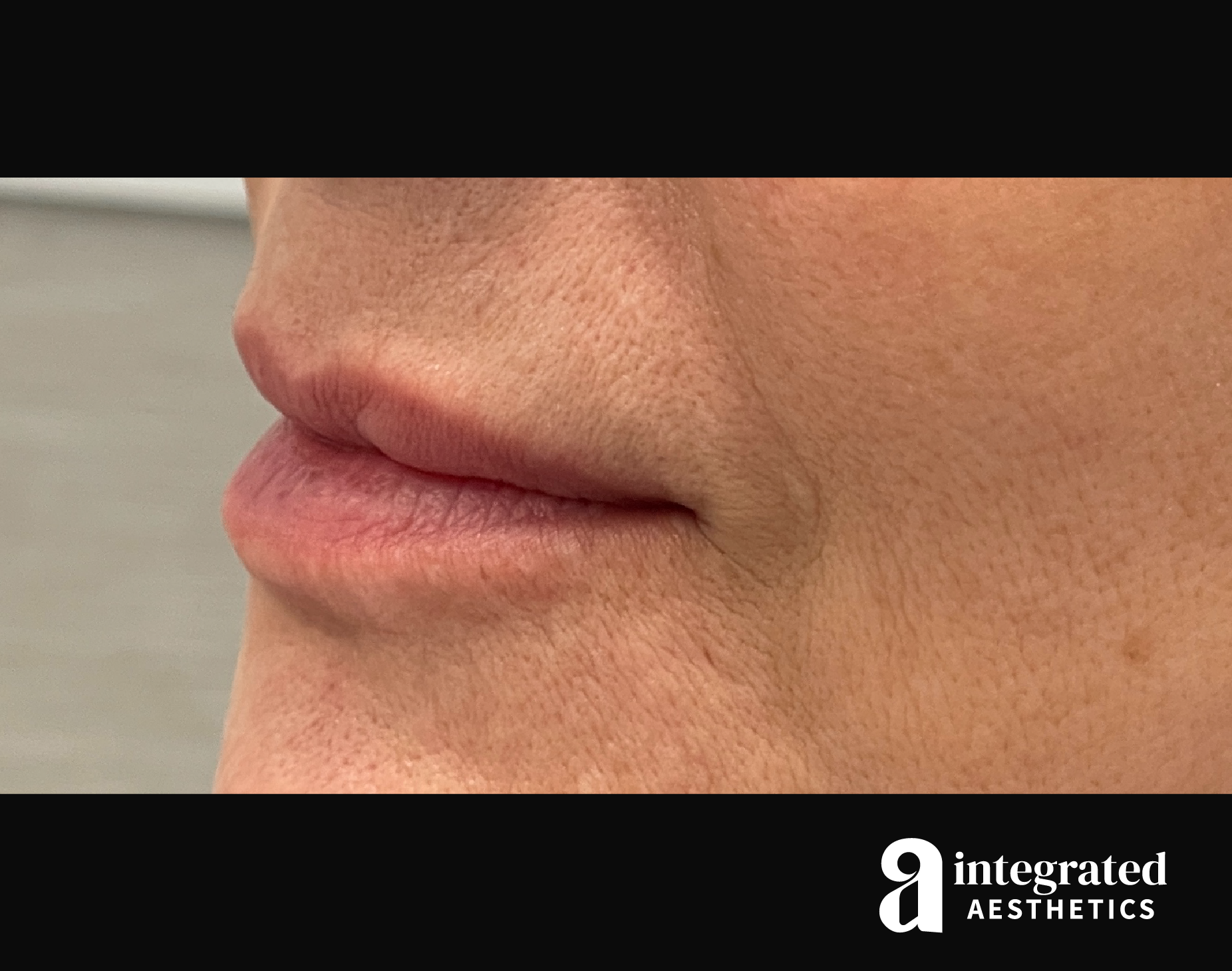 Dermal Fillers Before & After Gallery - Patient 133212672 - Image 9