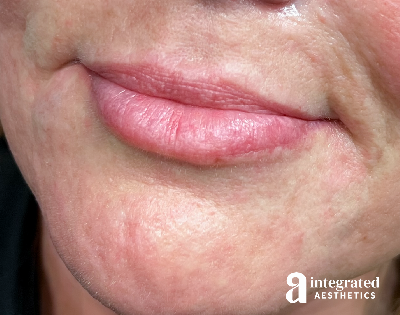 Dermal Fillers Before & After Gallery - Patient 133212673 - Image 1